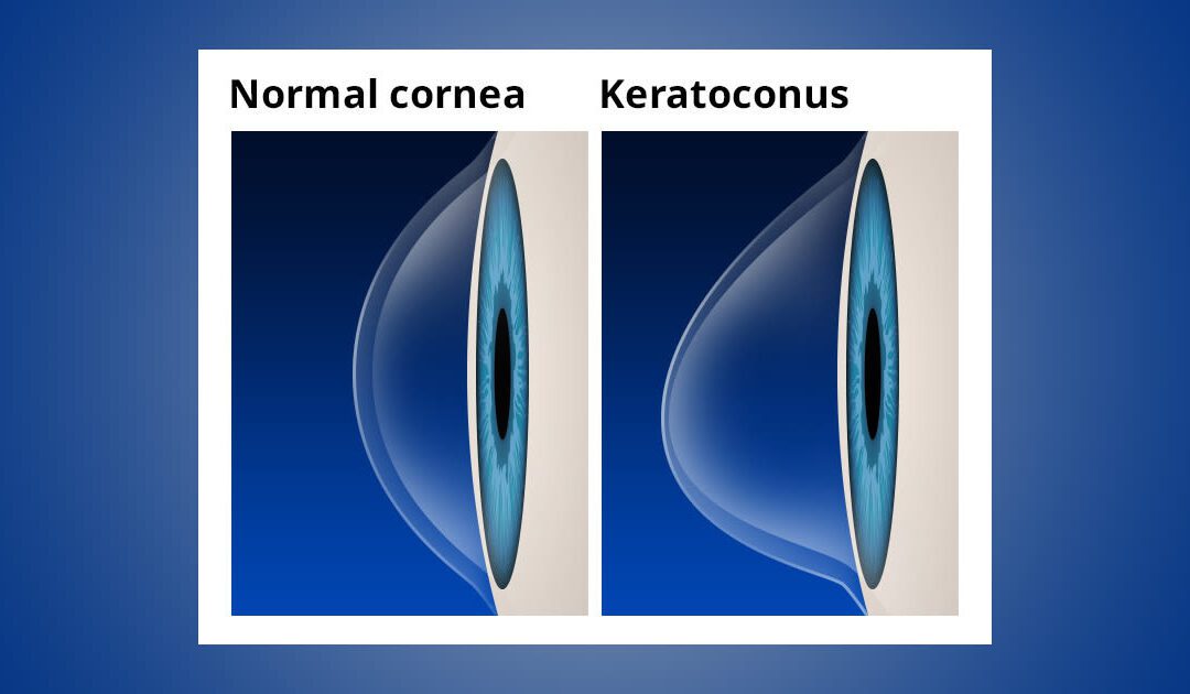 keratoconus